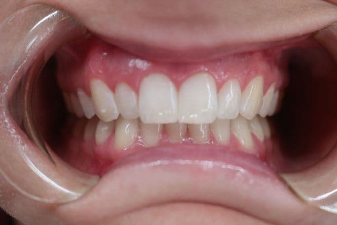 Skin before microneedling treatment